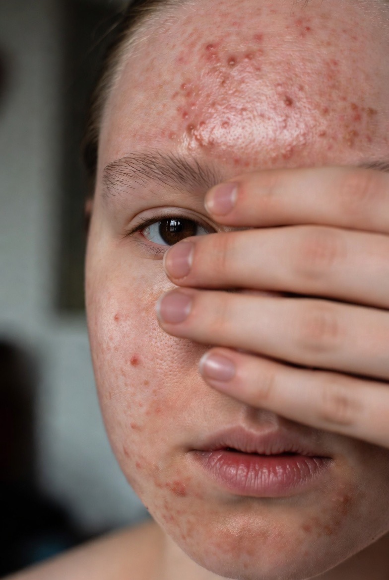Akne – Was hilft wirklich?